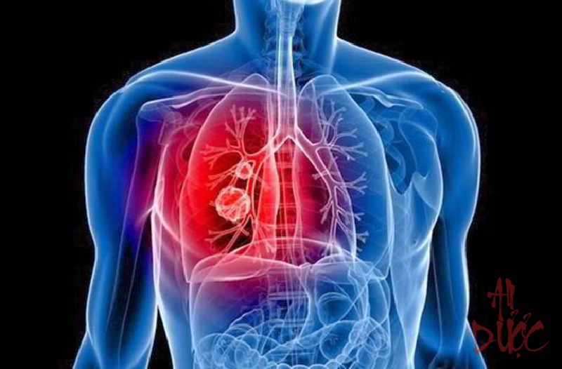 Đau vùng lưng sau phổi trái phải là bệnh gì
